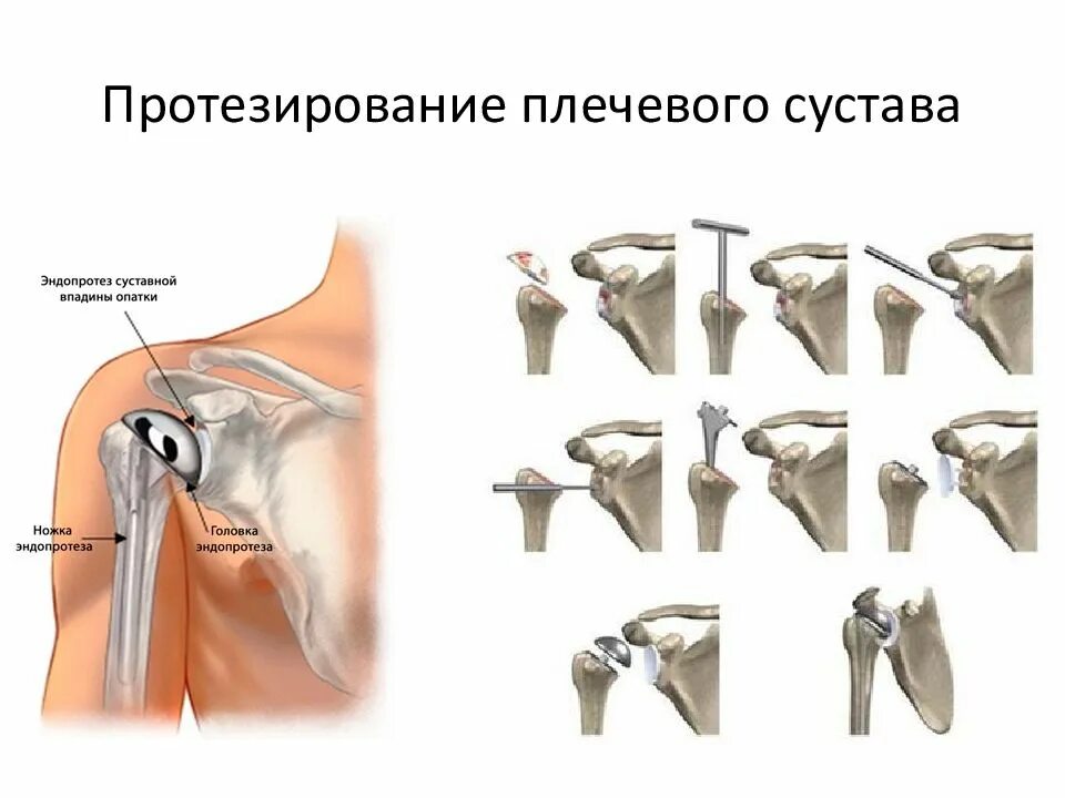 Операция по замене плечевого сустава. Эндопротез плечевого сустава. Плечевой сустав с захватом плечевой кости. Имплант плечевого сустава. Реверсивный протез плечевого сустава.