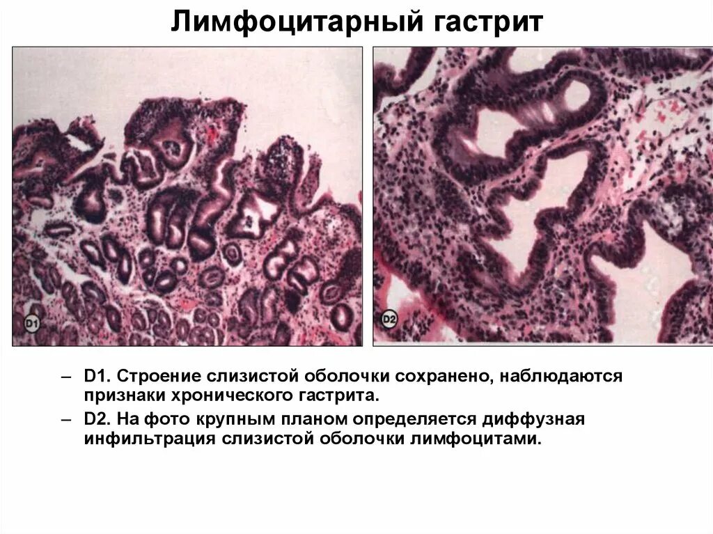 Биоптат слизистой оболочки. Лимфоцитарный гастрит гистология. Хронический лимфоцитарный гастрит. Некротический гастрит патанатомия. Лимфоидная инфильтрация гистология.