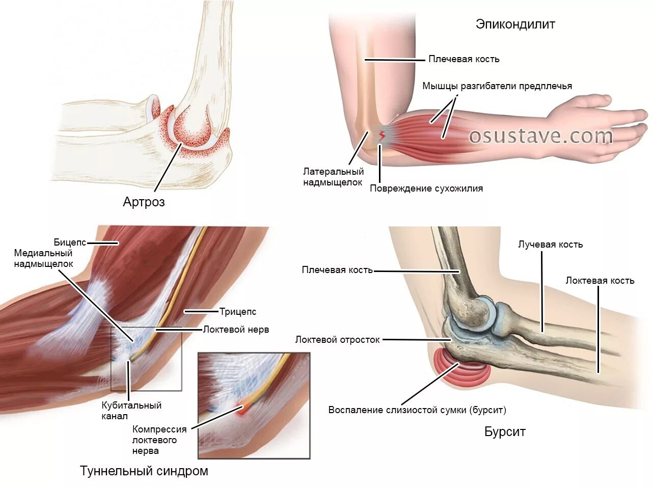 Почему болят локтевые сгибы. Связочный аппарат локтевого сустава. Болят кости руки сбоку локтя. Локоть сустав болит косточка сбоку.