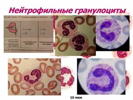 Нейтрофильное воспаление