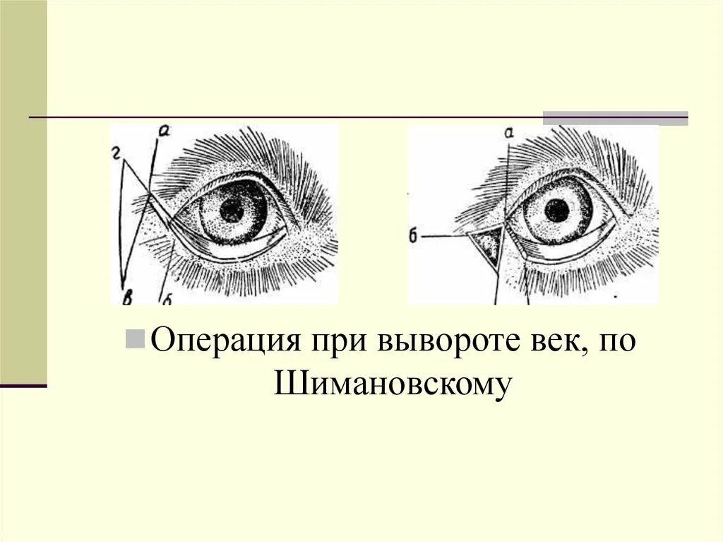 Веки являются тест. Операция по вывороту век по Шимановскому. Операция при вывороте век животных. Операции при вывороте век по Шимановскому.