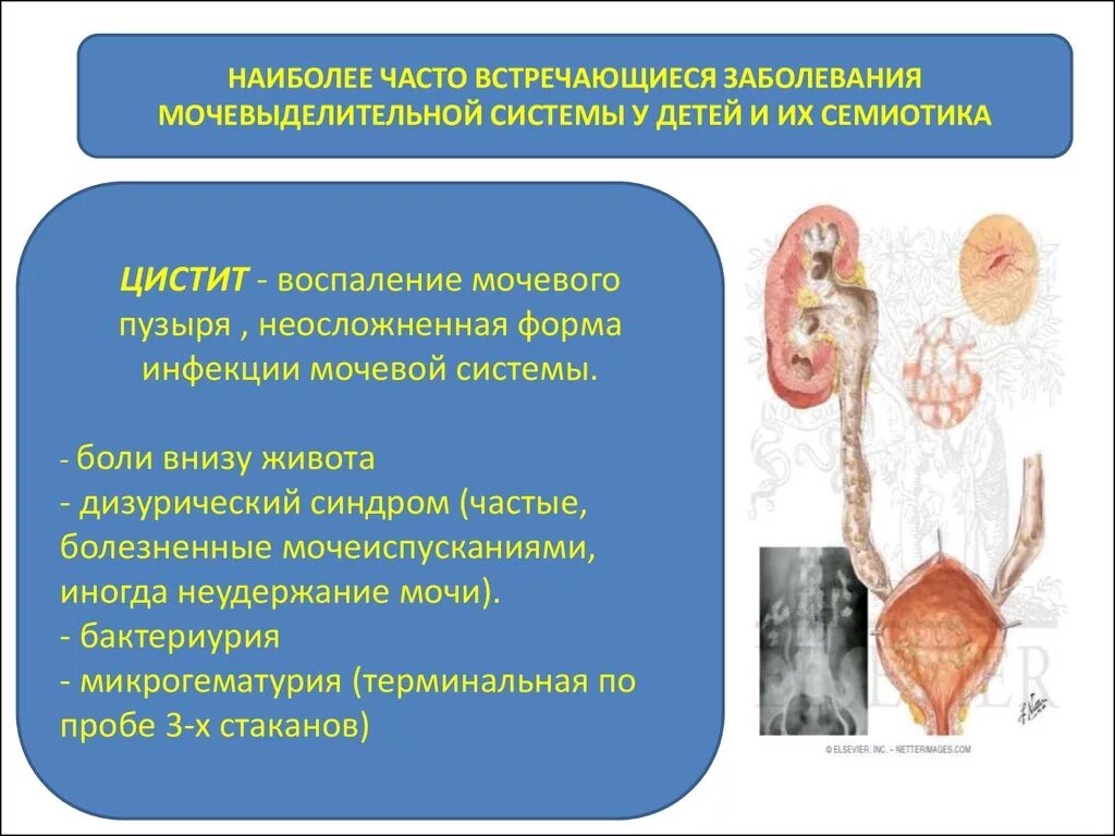 Заболевания почек и мочевого пузыря. Заболевания мочевыделительной системы цистит. Наиболее часто встречающиеся заболевания мочевой системы. Болезни мочевыделительной системы у детей. Болезни выделительной системы у детей.