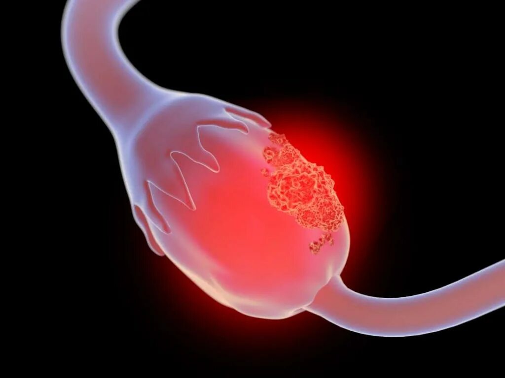 Доброкачественная опухоль яичника клинические. Злокачественные новообразования яичников. Злокачественные заболевания яичников. Раковая опухоль яичника.