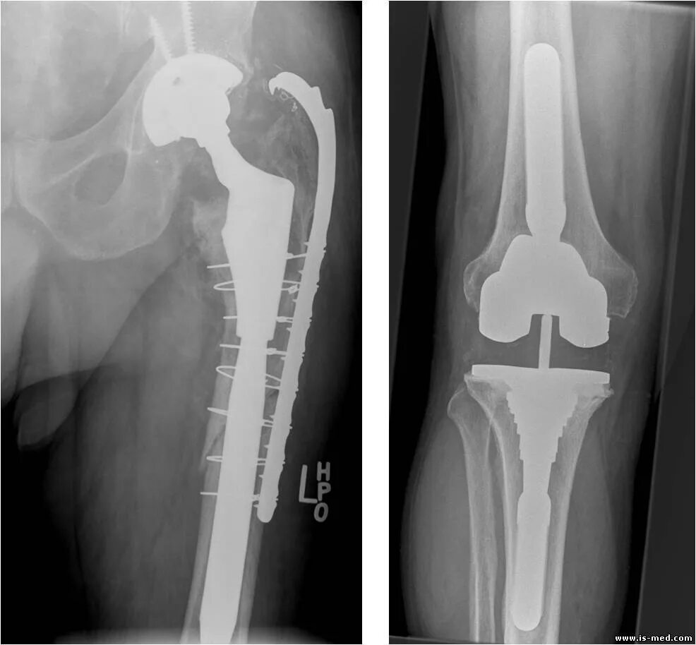 ТБС тазобедренного сустава. Эндопротез бедренной кости. Эндопротезирование коленного сустава рентген. Остеосинтез плечевого сустава.