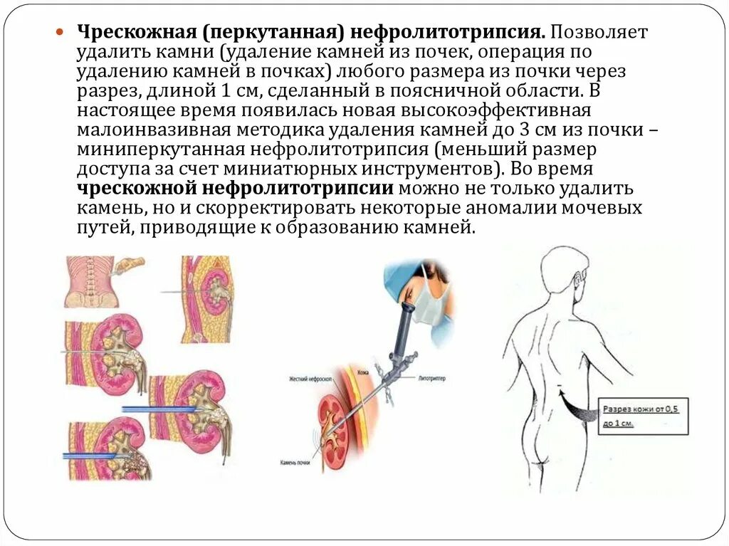 Через легкие удаляются. Чрескожная нефролитотомия. Чрескожная нефролитолапаксия. Перкутанная нефролитотрипсия почек.