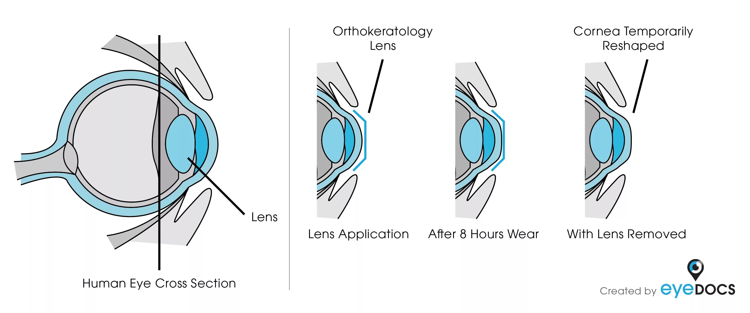 Жесткие ночные ортокератологические линзы. Ортокератология ночные линзы. Ночные жесткие линзы для восстановления зрения. Как работают ортокератологические линзы. Зрение 2 операция