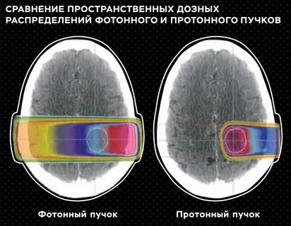 Протонная и фотонная терапия