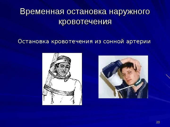 Остановить кровотечение на сонной артерии ответ тест. Остановка кровотечения из сонной артерии. Кровотечение из сонной артерии. Временная остановка кровотечения из сонной артерии. Способ остановки кровотечения из сонной артерии.