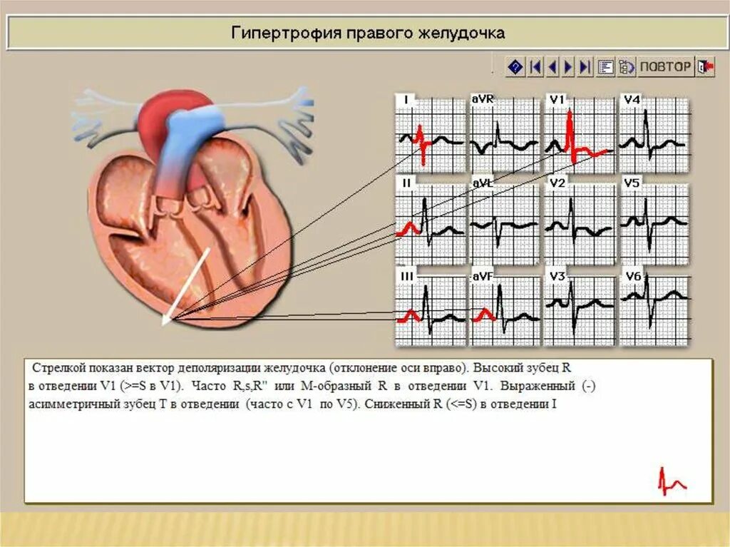 Причины гипертрофии левого желудочка. 2. Гипертрофия правого желудочка:. S Тип гипертрофии правого желудочка. Гипертрофия правого желудочка r Тип s Тип. Гипертрофия правых отделов сердца на ЭКГ.