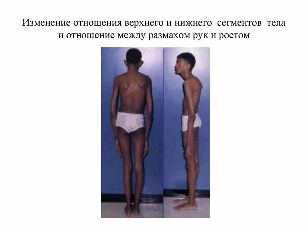 Сегментированное туловище. Соотношение верхнего и нижнего сегмента тела. сегментированное тело. нижняя и верхний отношения. отношение длины верхнего сегмента тела к нижнему.