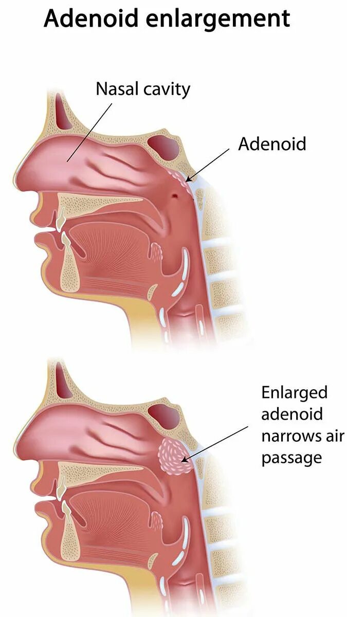 Анатомия ЛОР органов аденоиды. Аденоиды b TDCF[BTDF nhe,FУ детей. Аденоиды и евстахиева труба.