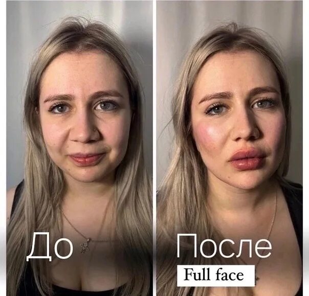 До и после - инъекционная косметология Результаты процедур в клинике медицинской