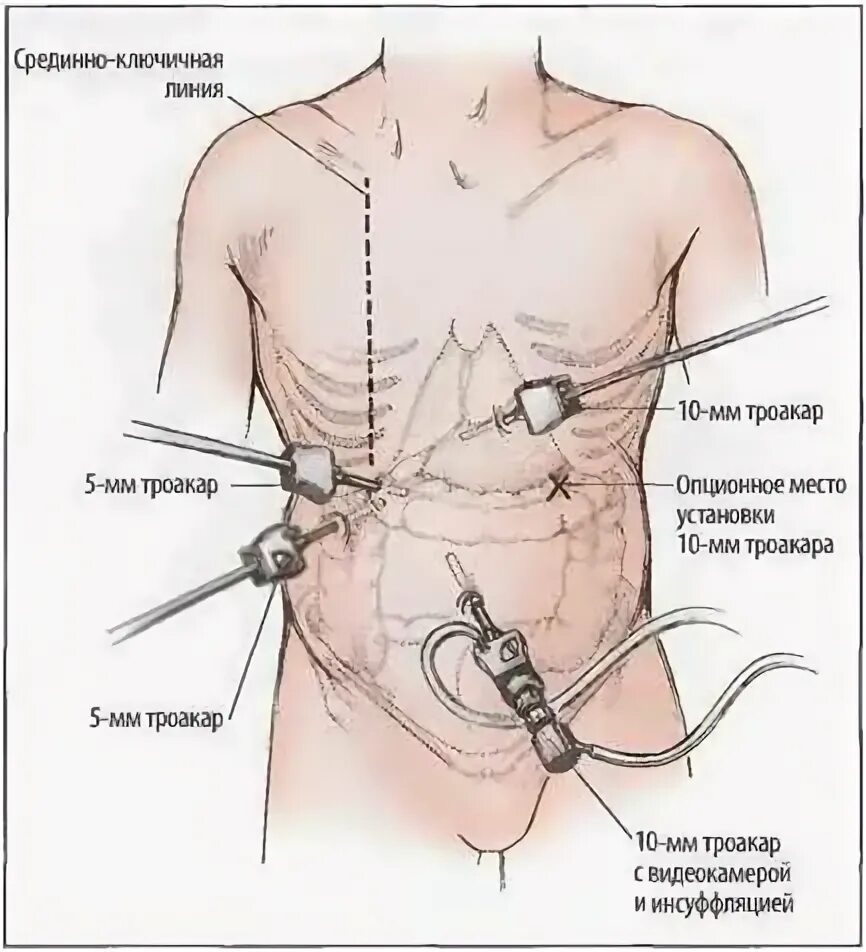 Удаление желчного больничный сколько дней. Лапаротомия холецистэктомия. Схема установки портов при лапароскопической холецистэктомии. Лапароскопическая холецистэктомия схема вмешательства. Точки доступа при лапароскопической холецистэктомии.