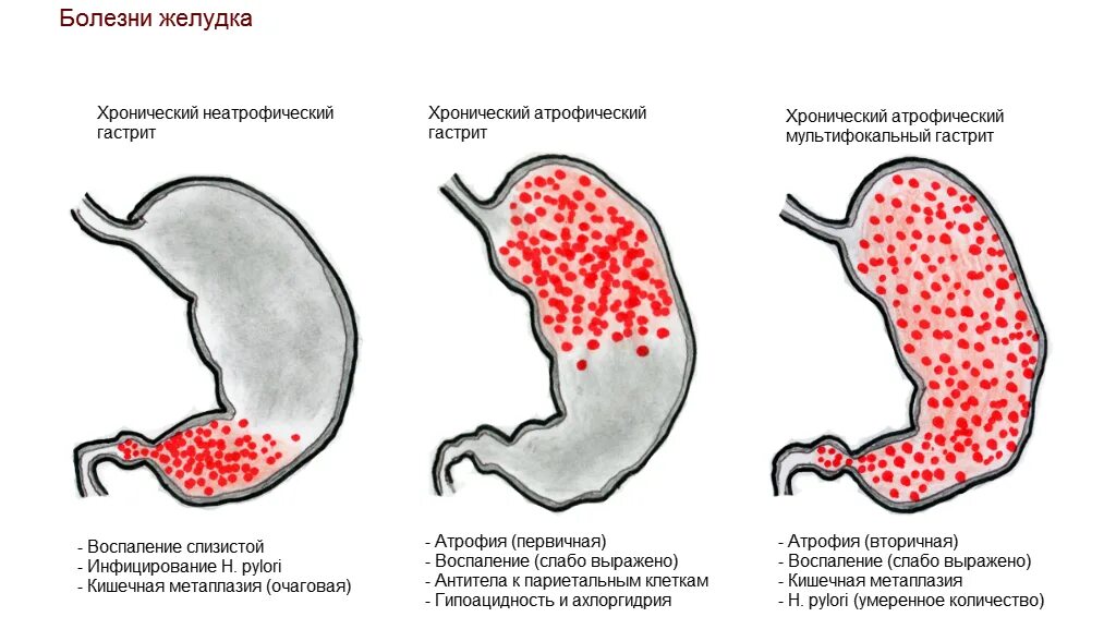 Поражение слизистой оболочки желудка с воспалительными изменениями.. Хронический атрофический гастрит синдромы. Хронический неатрофический гастрит симптомы. Хронический неатрофический очаговый гастрит. Слизистая атрофична