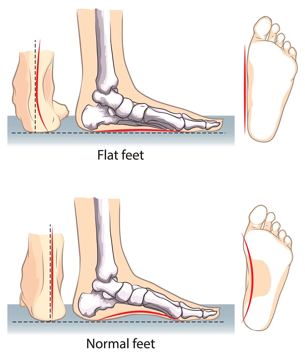 Плоскостопие на одной ноге берут ли. Нормальная стопа и плоскостопие. Как выглядит плоскостопие сбоку. Стопа анатомия плоскостопие. Степени плоскостопия вид сбоку.