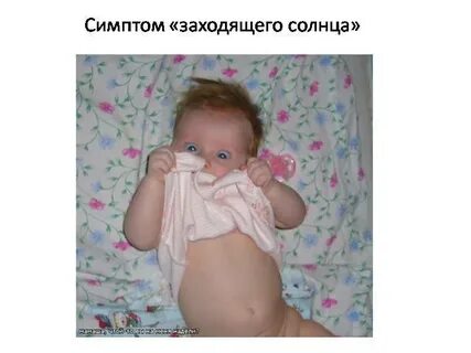 Симптом восходящего солнца