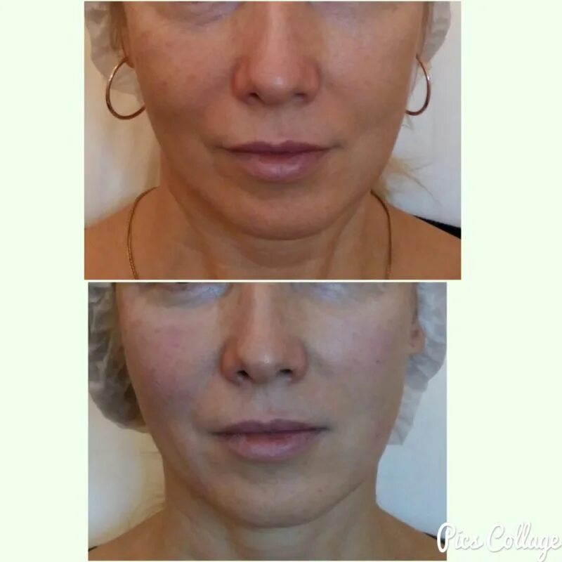 Sculptra полимолочная кислота. Полимолочная кислота канюлей. Полимолочная кислота AESTHEFILL. Эльдерморфил полимолочная кислота.