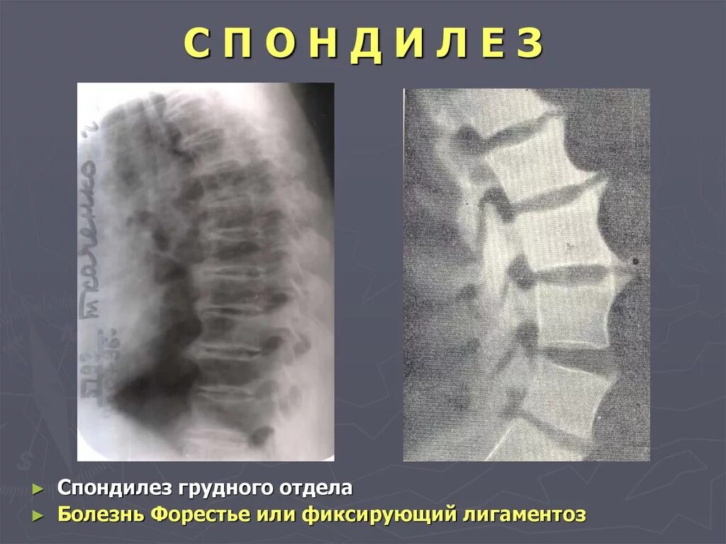 Спондилез грудного. Болезнь бехтерева грудной отдел позвоночника рентген. спондилез грудного отдела позвоночника рентген. деформирующий спондилез грудного отдела позвоночника рентген. болезнь форестье шейного отдела рентген.