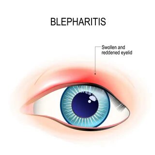 Blepharitis латынь