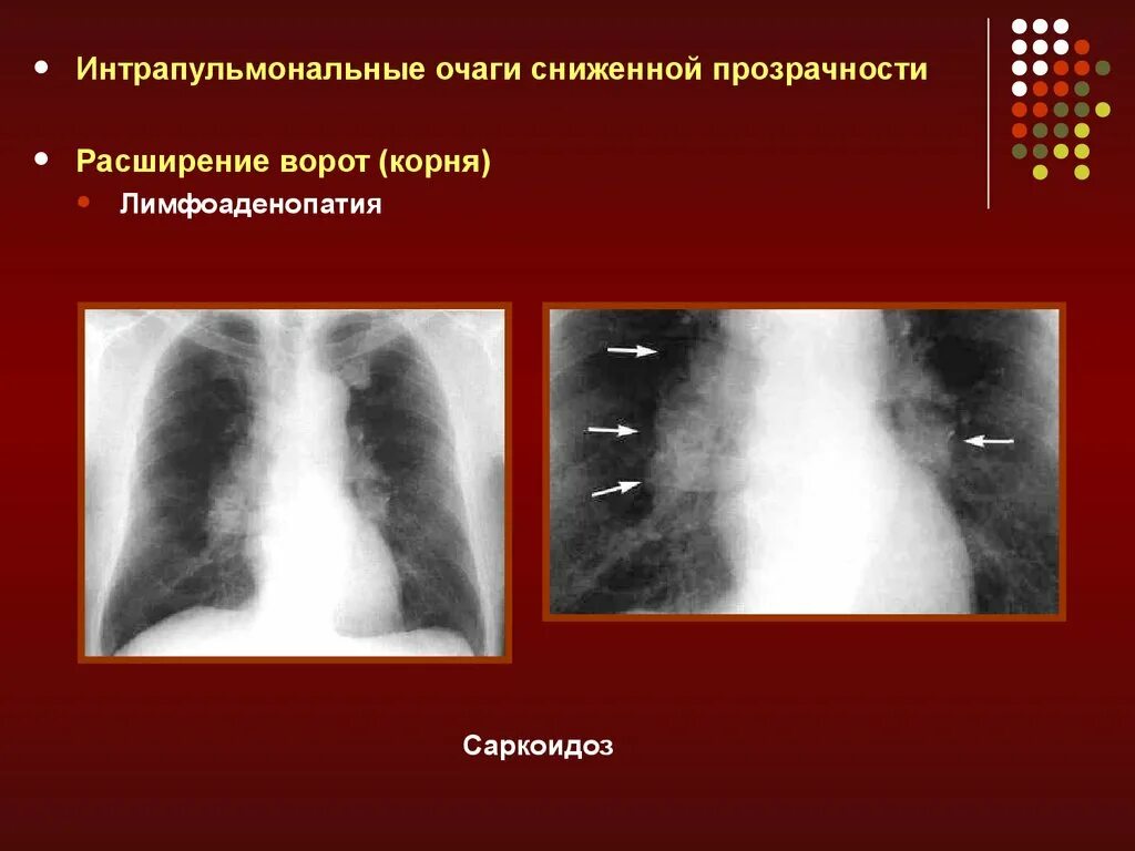 Limfadenopatiya bnutrigrudnix limfouzlov. Медиастинально-легочный саркоидоз. Лимфаденопатия внутригрудных лимфоузлов саркоидоз. Саркоидоз внутригрудных лимфоузлов рентген. Как лечить внутригрудную лимфаденопатию