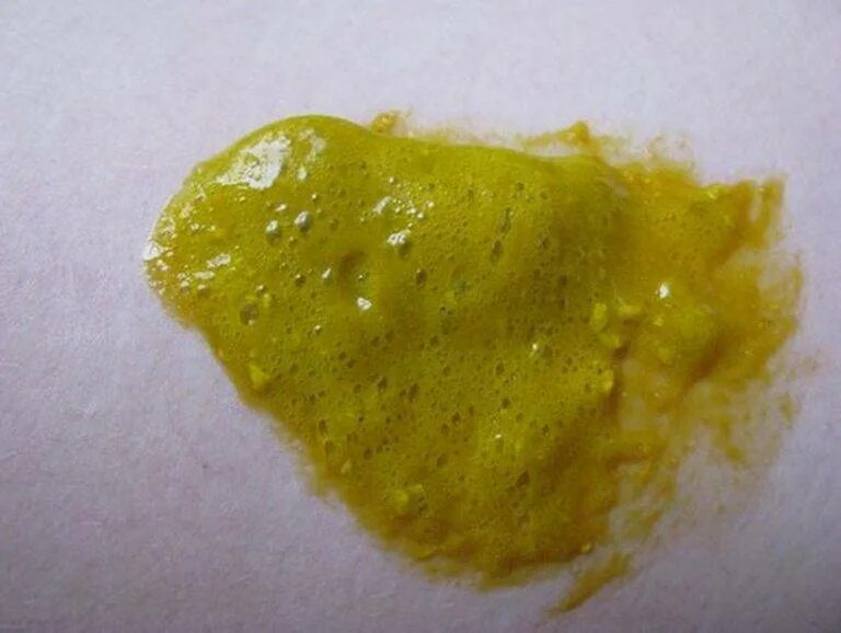 Виды диарей классификация. Кал при лактозной недостаточности. Понос 5 лет. Нормальный кал у грудничка. Норма кала у грудничка на грудном вскармливании.