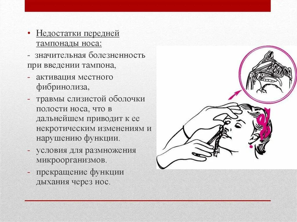 Передняя тампонада при носовом кровотечении. Передняя тампонада носа. Носовая тампонада алгоритм. Тампонада носа алгоритм. Тампонирование носа при кровотечении.