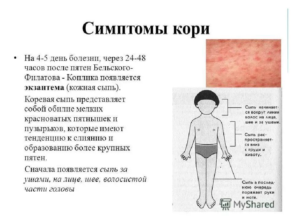 Какое лечение при кори. Сыпь корь краснуха сыпь. признак характерный для сыпи при кори. первые элементы сыпи при кори у детей появляются на.