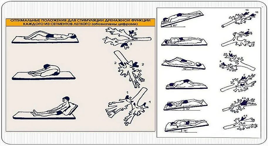 Постуральный массаж. Дыхательная гимнастика и Постуральный дренаж. Дринадное положение для от хождения макроты. Постуральный дренаж бронхов алгоритм. Позиционный Постуральный дренаж алгоритм.