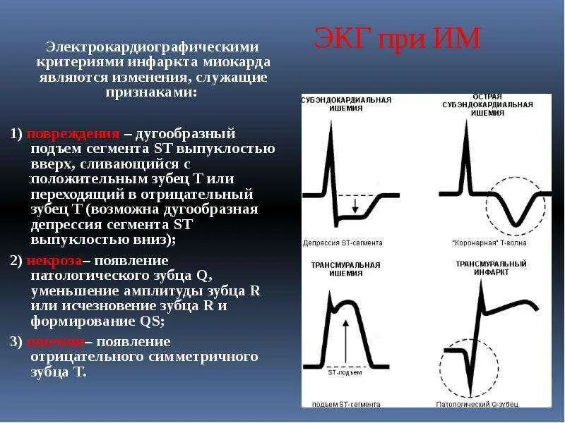 Диффузные повреждения на экг что значит. Подъем сегмента st на экг на 3 мм. экг зубец т отрицательный v5. отрицательный зубец р после qrs комплекса. экг отрицательные зубцы t в v2-v5.