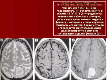 Менингиомы отзывы