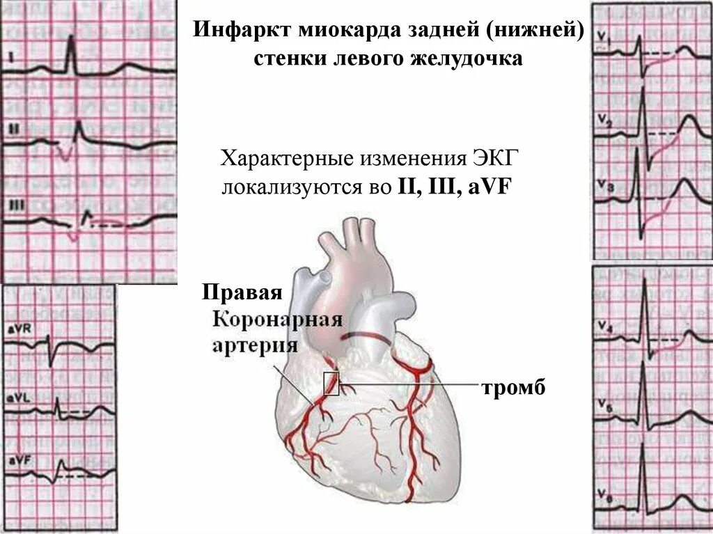 Инфаркт миокарда нижнебоковой стенки. Острый инфаркт миокарда нижней стенки на ЭКГ. Старый инфаркт миокарда передней стенки ЭКГ. Нижне диафрагмальный инфаркт миокарда на ЭКГ. Изменение боковой стенки левого желудочка