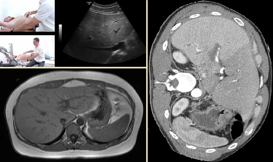 Гепатоза гепатомегалии. Гепатомегалия и спленомегалия. Гепатомегалия синдром. Гепатоспленомегалия на кт. Гепатоспленомегалия на УЗИ.