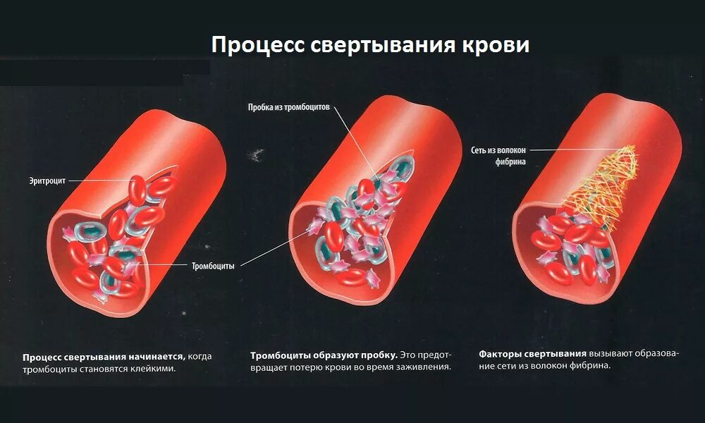 Образование тромба из фибрина