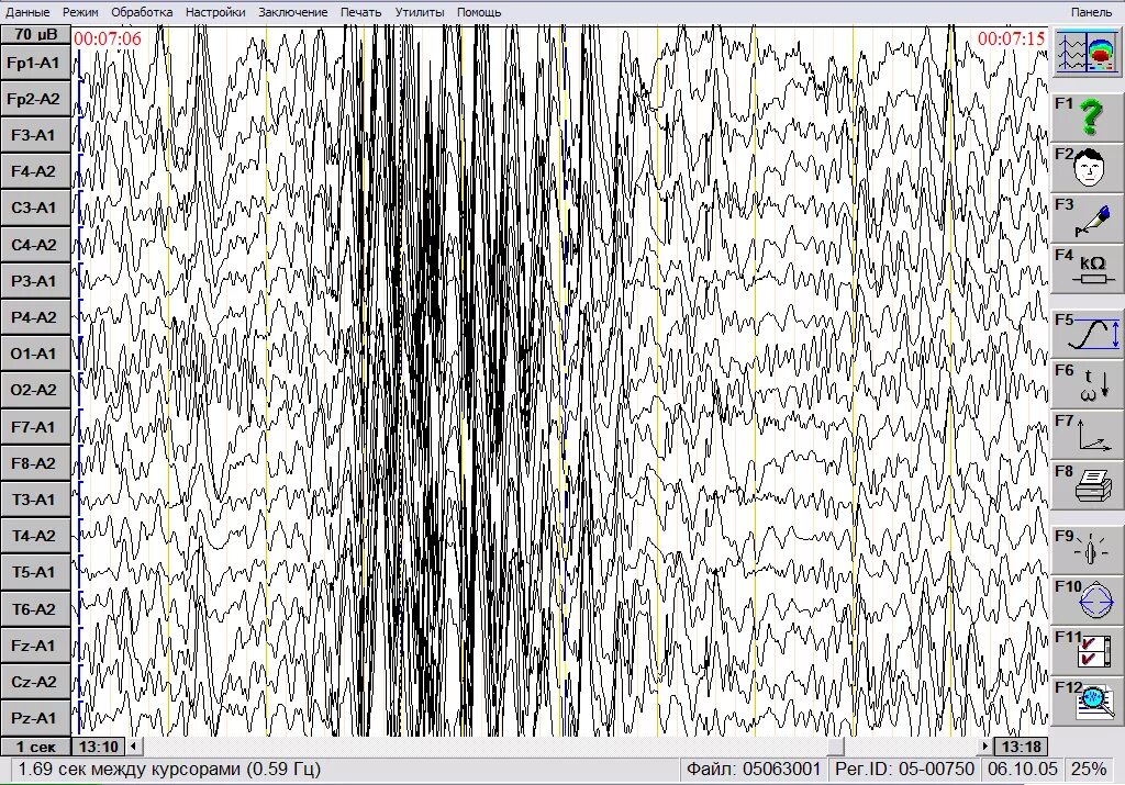 Эпи ээг. Эпиактивность на ЭЭГ. ЭЭГ В психиатрии. Эпилептический статус ЭЭГ. Эпи активность при ЭЭГ.