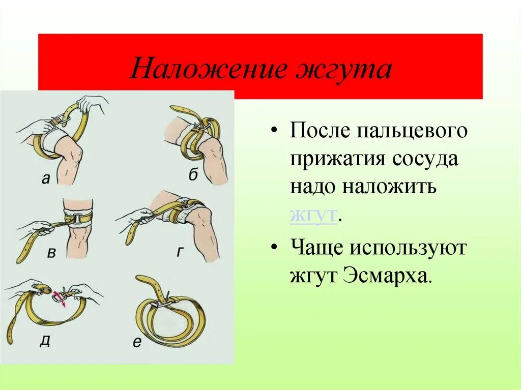 Правила наложения кровоостанавливающего жгута при кровотечении. Наложение артериального жгута Эсмарха. Как правильно накладывать жгут. Наложение кровоостанавливающего жгута Эсмарха. Как правильно наложить артериальный жгут