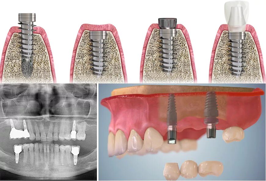 Имплантация зубов какие лучше