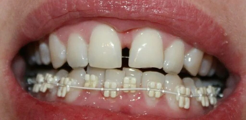 Можно ли поставить только верхнюю челюсть. Можно ли поставить только верхнюю челюсть. Можно ли поставить только верхнюю челюсть. Мезиальный перекрестный прикус. Брекеты на верхние и нижние зубы.