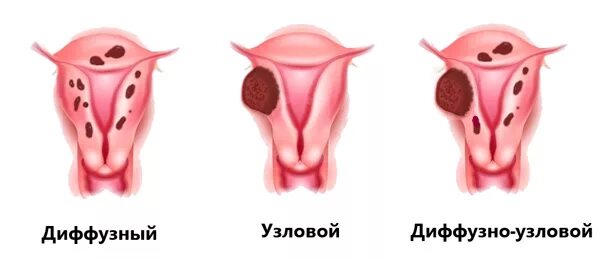 Аденомиоз диффузные изменения. Аденомиоз диффузная форма. аденомиоз узловатой формы. диффузно-узловой аденомиоз.