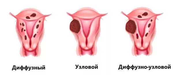 Узловая форма эндометриоза матки. Аденомиоз 1 степени.Узловая форма. Аденомиоз 1 степени диффузная форма. Эндометриоз аденомиоз матки. Диффузно узловая форма