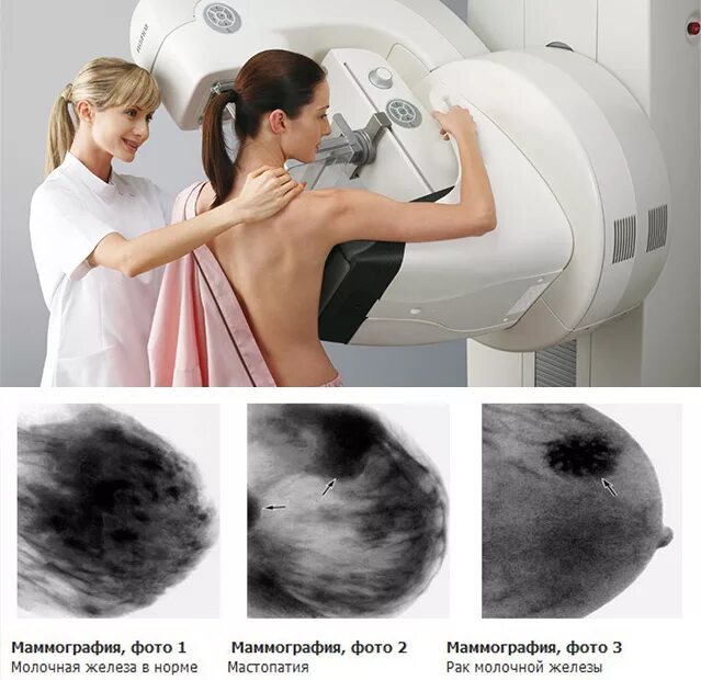 Маммография обязательно. Маммография рентген снимки. Рентген молочных желез маммография аппарат. Маммография УЗИ молочных желез. Билатеральная маммография.