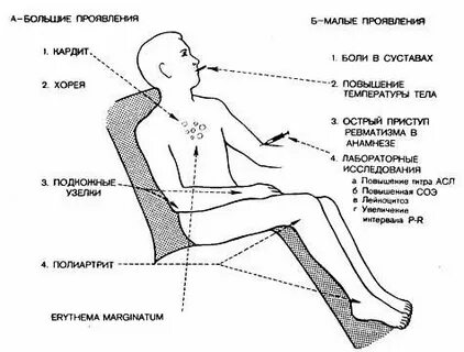 Симптомы ревматизма у взрослых