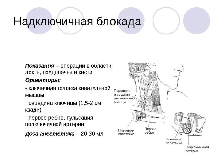 Блокада сплетения. Блокада плечевого сплетения надключичным доступом. Надключичная блокада по Куленкампфу. Надключичная блокада УЗИ.