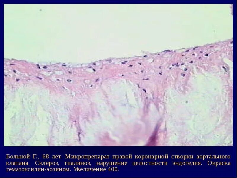 Макропрепарат стеноз аортального клапана. Атеросклероз аорты микропрепарат. Аортальная недостаточность макропрепарат.