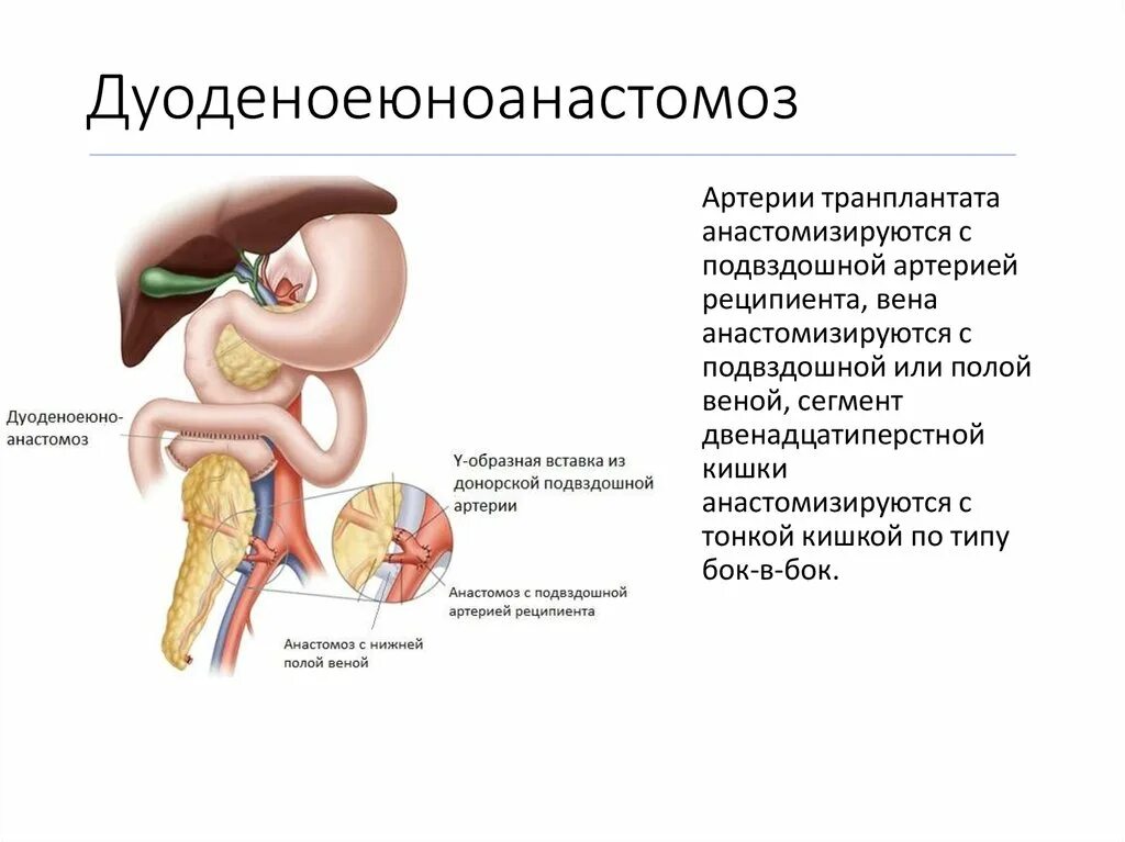 Дуоденоеюноанастомоз по ру. Дуодено дуоденоанастомоз. Трансплантация поджелудочной железы. Пересадка поджелудочной в россии