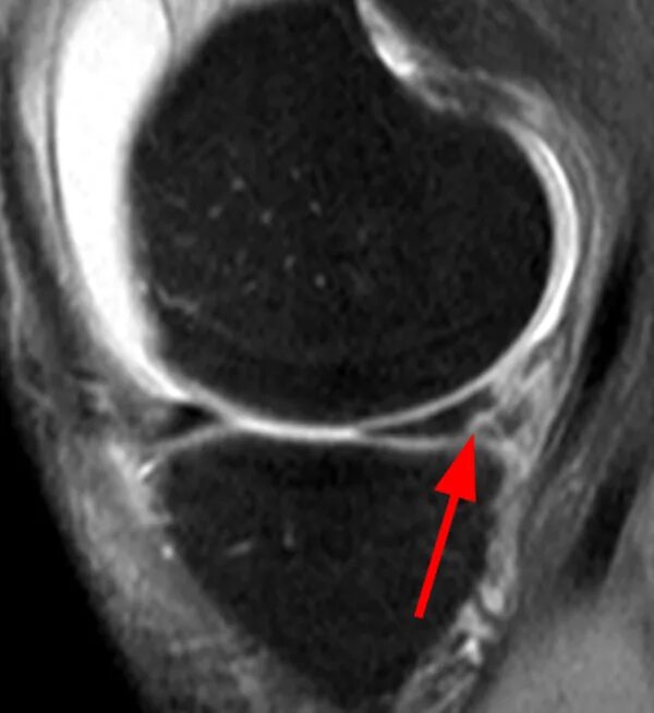 Разрыв мениска мрт. Разрыв корня мениска коленного сустава мрт. Повреждение заднего рога медиального мениска Stoller 2. Задний Рог мениска повреждение.
