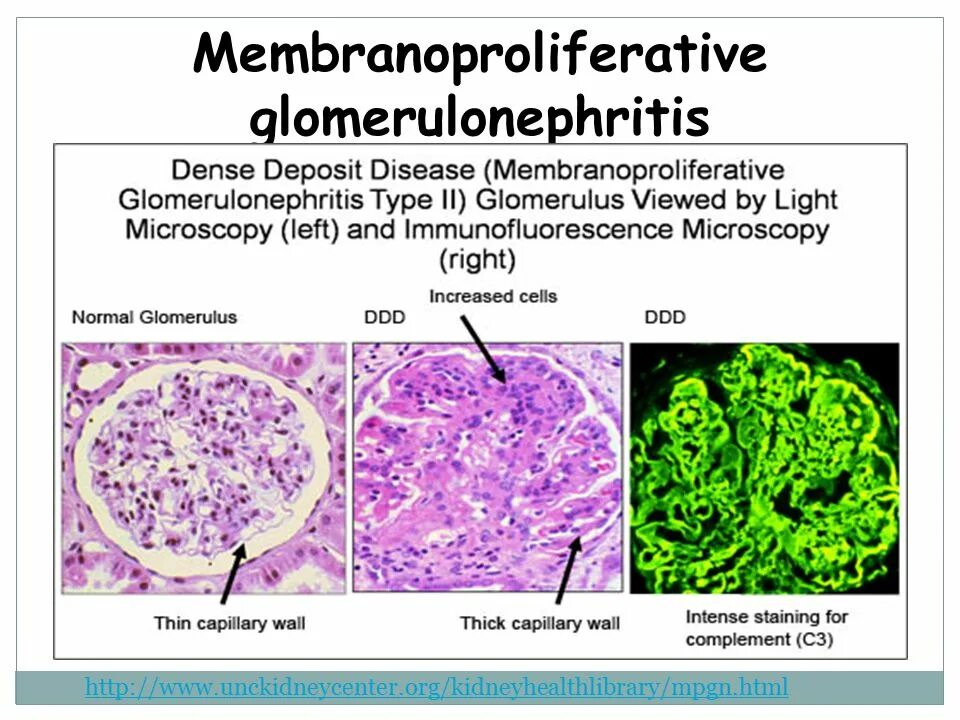 Мембранопролиферативный гломерулонефрит. Мембранопролиферативный гломерулонефрит 3 Тип. Морфология гломерулонефрита. Гломерулонефрит мембранопролиферативный макро. Dense перевод