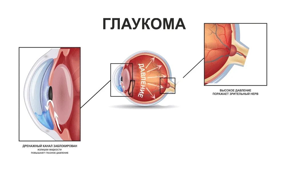 Презентация на тему глаукома. Глоэкома. Глколюкома.
