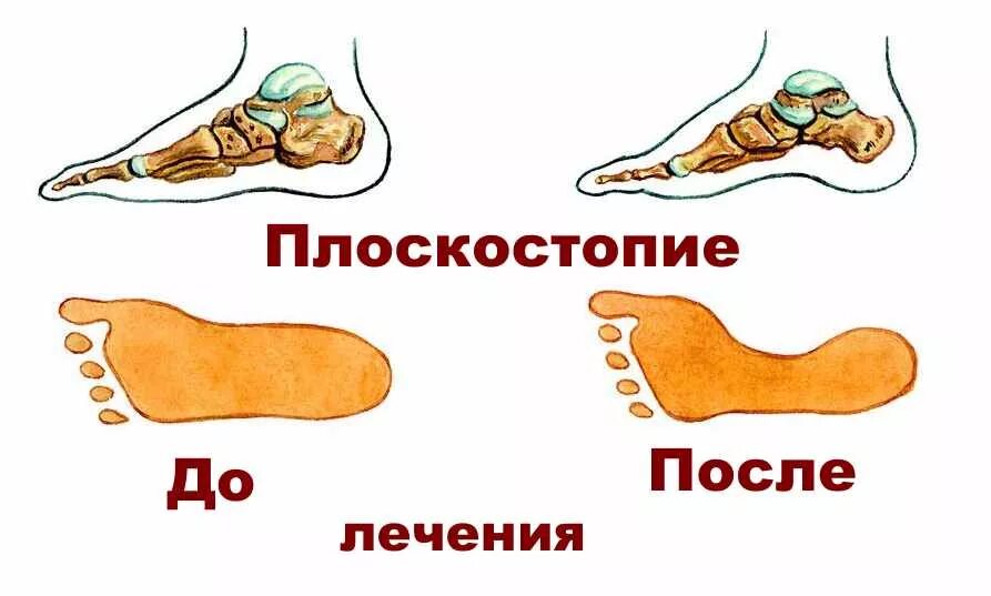 Как вылечить плоскостопие у взрослых. Плоскостопие. лечение плоскостопия. нет плоскостопия. плоскостопие лечится.