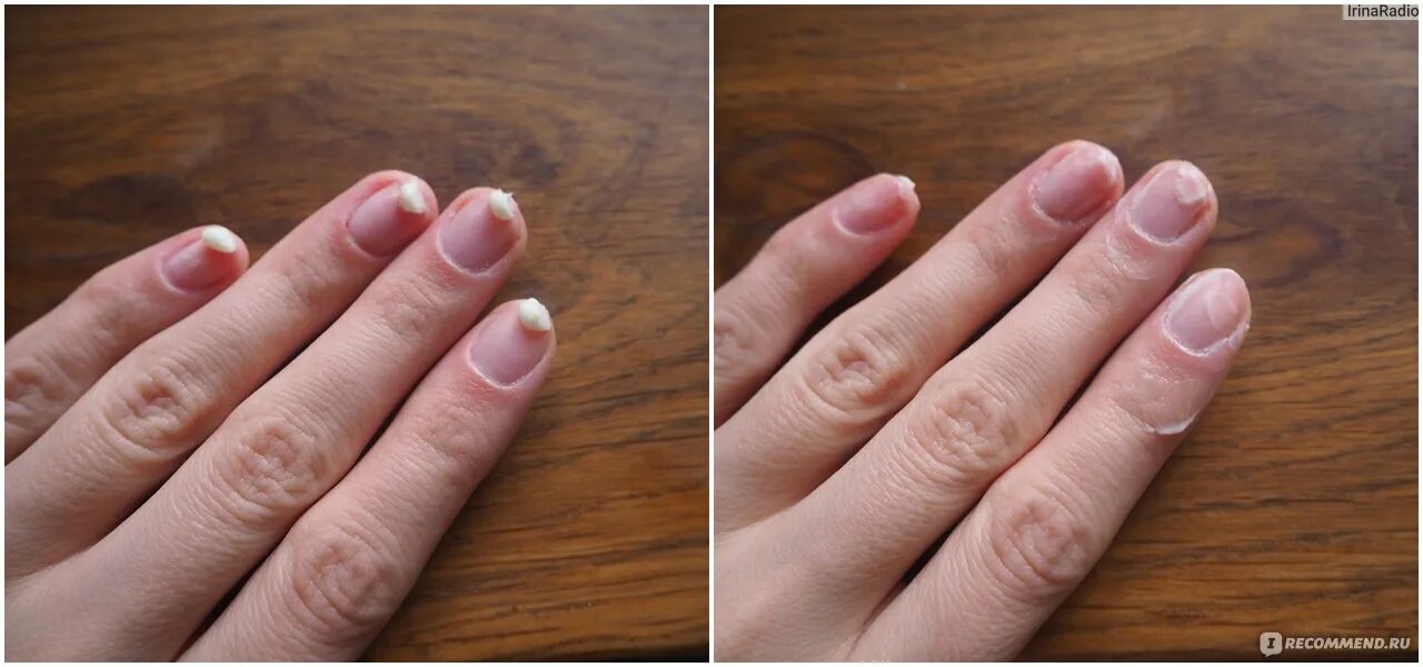 Сколько восстанавливается ноготь. Восстановление ногтевой пластины. Гель для восстановления ногтевой пластины. Средства для восстановления ногтей на руках.