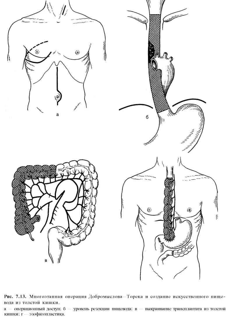 Искусственный пищевод. Операция Добромыслова Торека. Чресплевральная резекция грудного отдела пищевода. Операция Добромыслова-Торека пищевод. Операция Добромыслова-Торека схема.